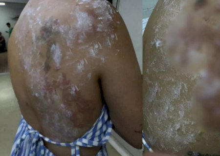 “Fiquei desesperada\', lembrou cliente que teve 20% do corpo queimado em bar famoso de Campo Grande